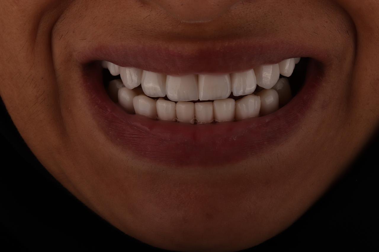 بعد زراعة - حالة 01