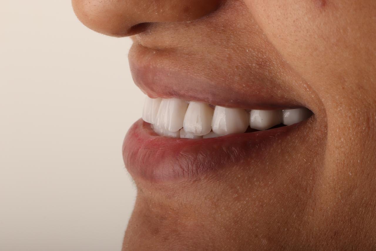 قبل زراعة - حالة 01