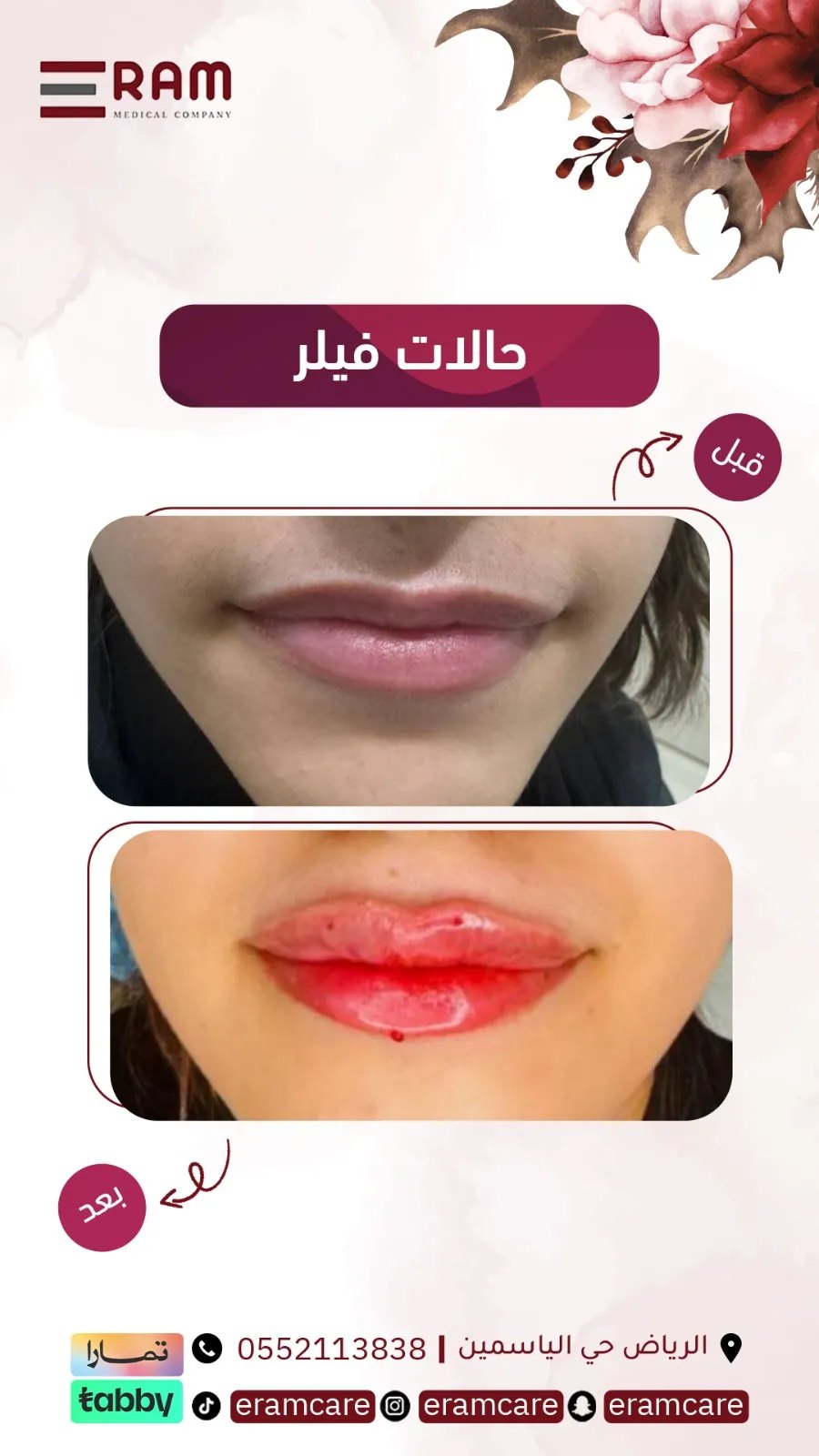 بعد زراعة - حالة 02