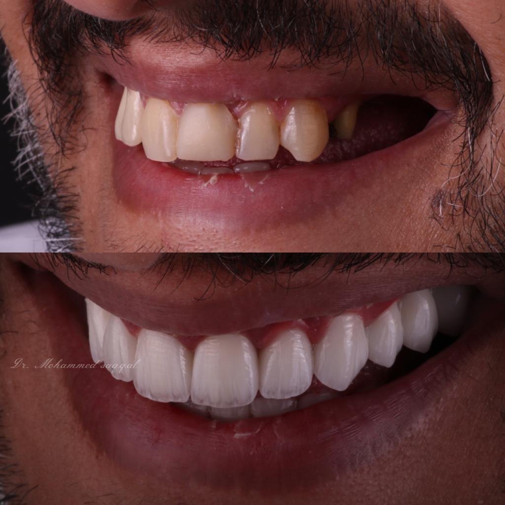 قبل زراعة - حالة 02