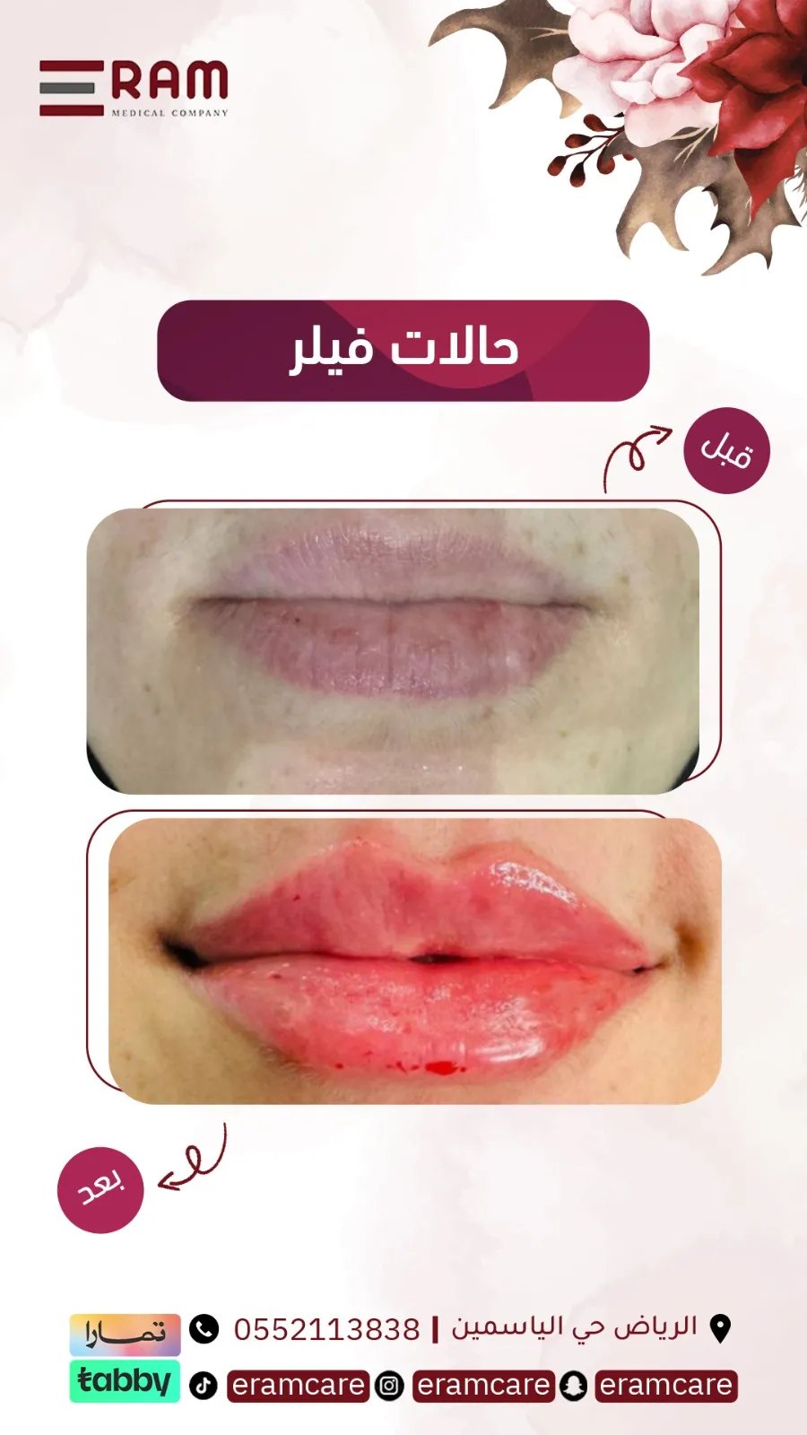 قبل تقويم - حالة 01